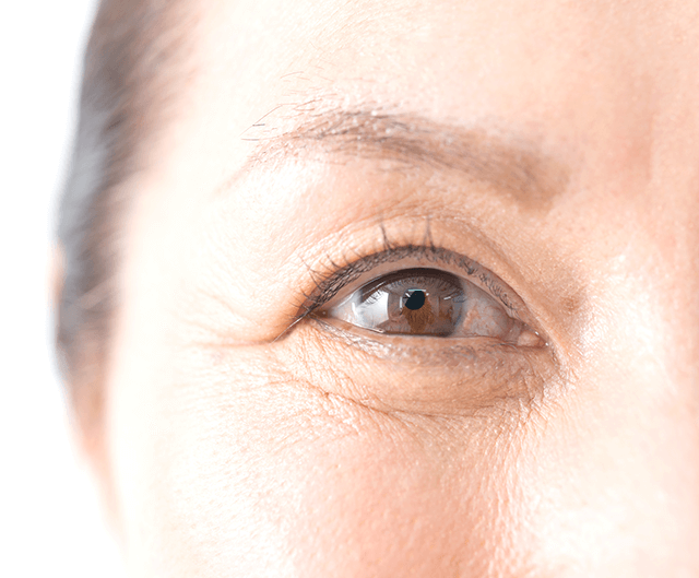 加齢黄斑変性症